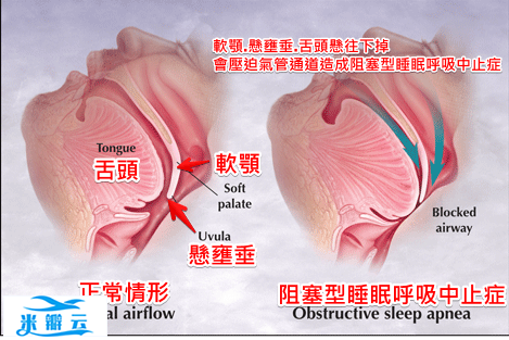 3种改善打鼾(呼)的训练