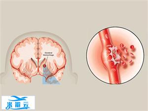 低LDL胆固醇和出血性卒中