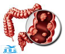 肺癌、肝癌、胃癌、大肠癌、乳腺癌、甲状腺癌等14种恶性肿瘤筛查与预防指南！