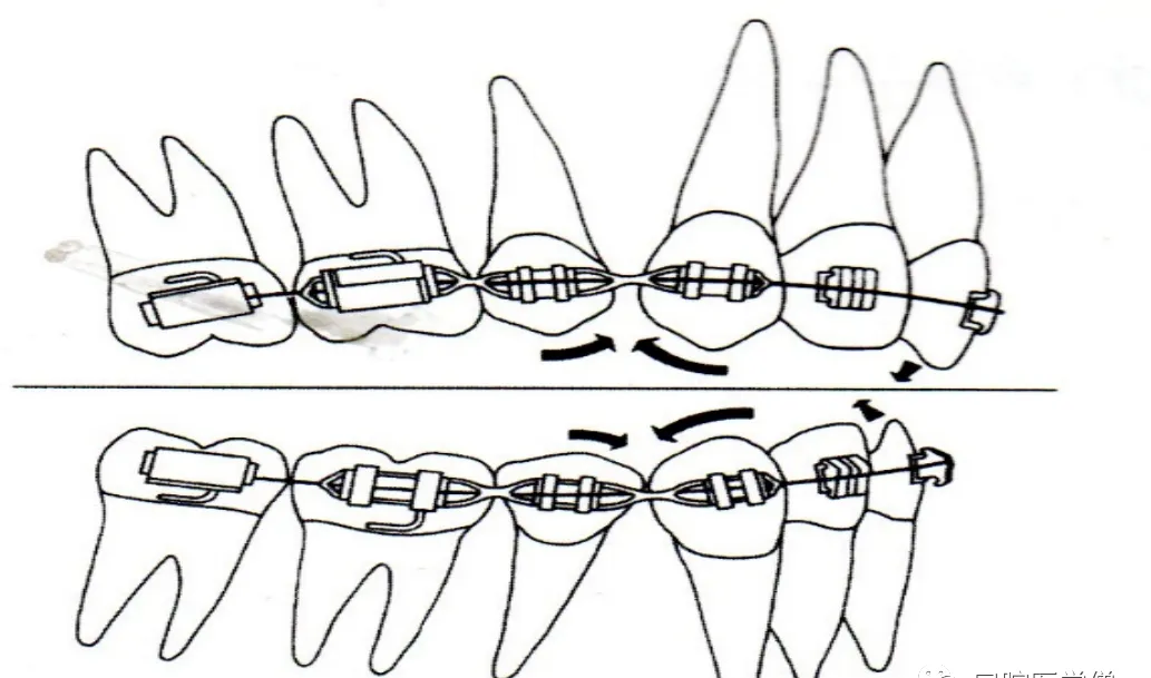 【学术科普】丨正畸中的过山车效应